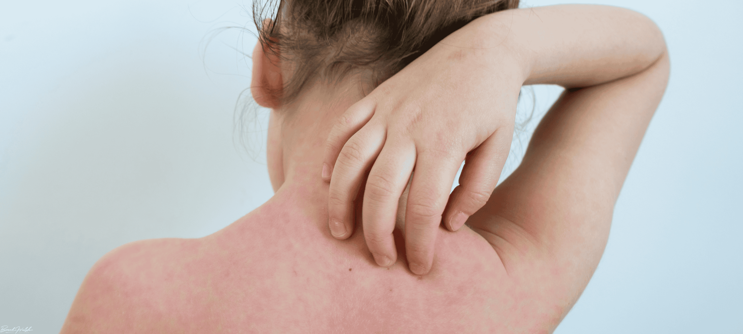 A swimmer scratching arm after swimming in Walloon Lake due to swimmers itch rash.